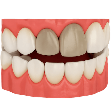 Blanqueamiento interno dental