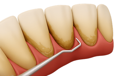 Acumulación de sarro