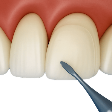 Carillas de composite