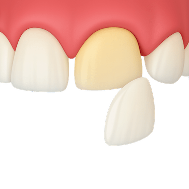Carillas de porcelana
