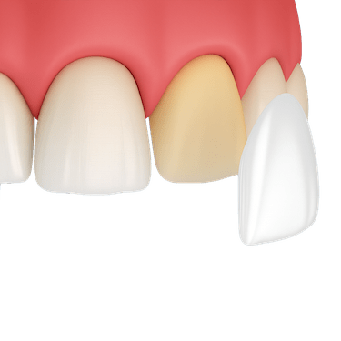 Carillas de zirconio