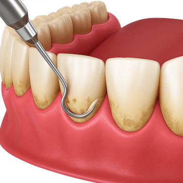 Limpieza interproximal