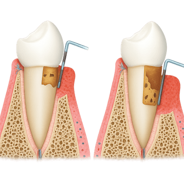 Limpieza dental profunda o curetaje