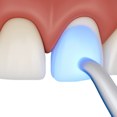 Microcarillas dentales