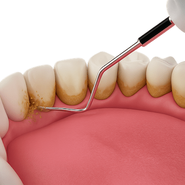 Limpieza dental con ultrasonido