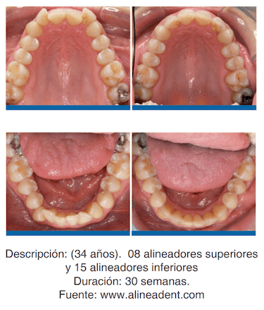 Alineadent antes y despues antes y despues y ortodoncia