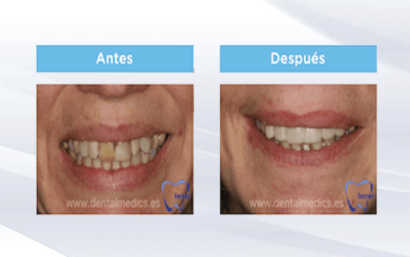 Carillas de composite