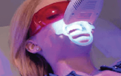 Preguntas frecuentes blanqueamiento dental en clínica