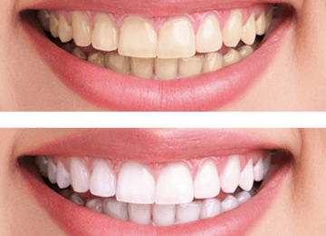 esteica dental en Madrid blanqueamiento Cosmetica dental Blanqueamiento