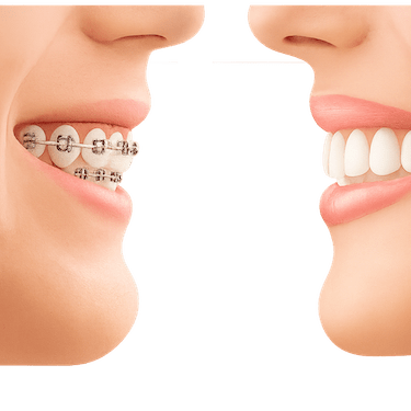 ¿Qué es mejor? ¿Brackets o Invisalign?