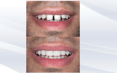 Carillas de porcelana