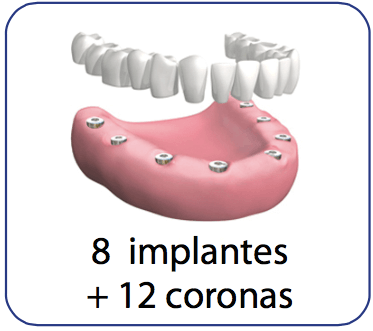 Completa de porcelana con implantes dentales protesis dental con implantes y coronas de porcelana