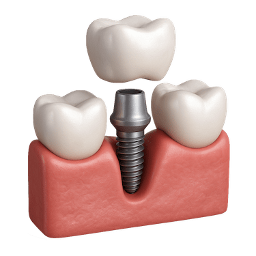 Coronas dentales sobre implante