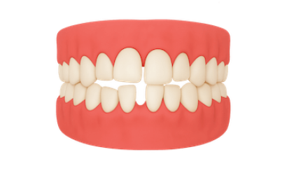 Diastema