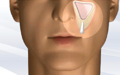 Elevación de seno maxilar y regeneración de hueso