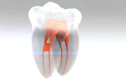 Endodoncia multirradicular