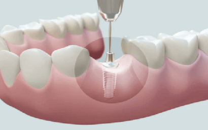 Implante o puente fijo