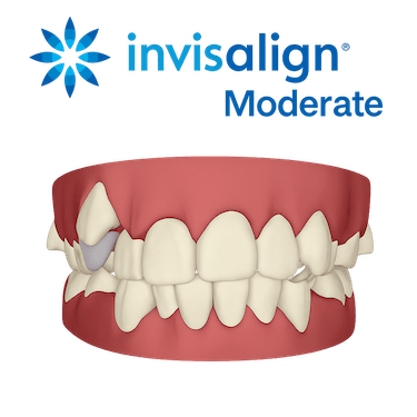 Invisalign Moderate