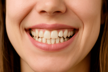Los brackets más eficaces para dientes torcidos