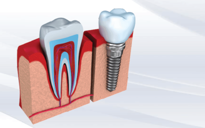 Preguntas frecuentes implantes dentales