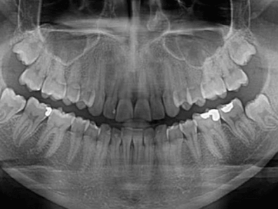 Radiografia panoramica dental rayos x dental panoramica