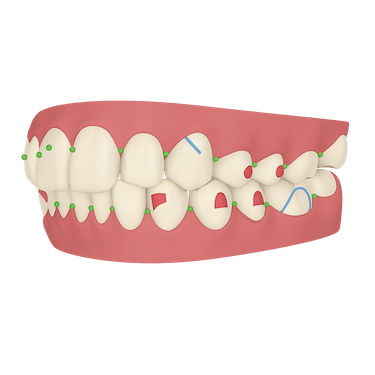 Refinamiento en Invisalign