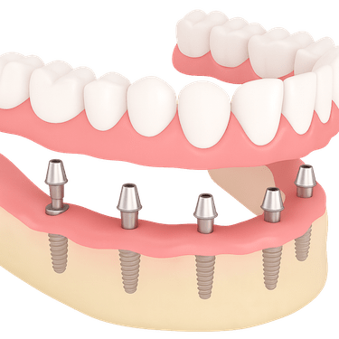 Carga inmediata con All-on-6