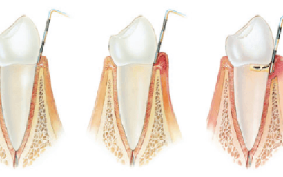 Tratamiento de la enfermedad periodontal