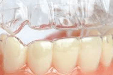 alineadores transparentes de ortodoncia ortodoncia invisible