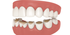 Bruxismo: qué es, causas y tratamientos