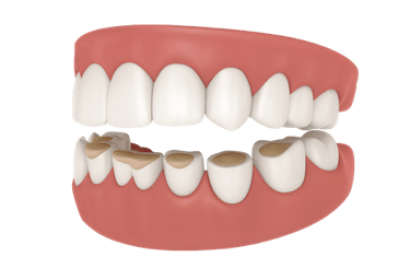 Bruxismo: qué es, causas y tratamientos