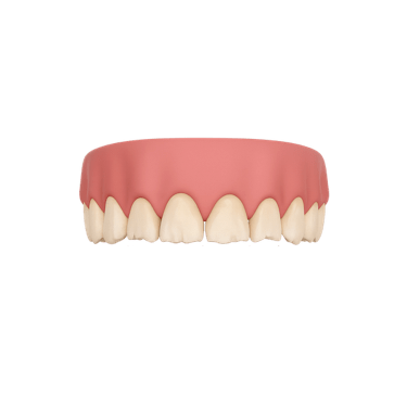 Bruxismo de grado II