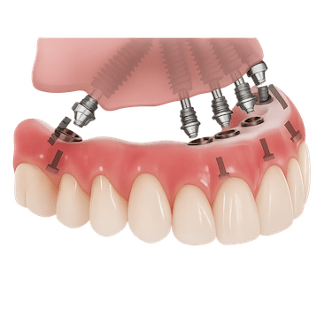 ¿Qué son los implantes de carga inmediata?