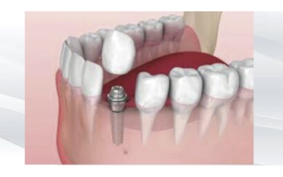 Complicaciones en implantes
