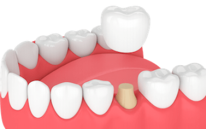 Diente fracturado o desgastado
