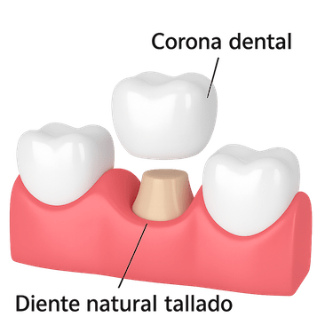 Corona sobre diente natural tallado
