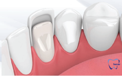 Cuidados de carillas