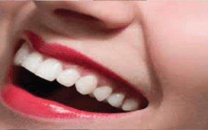 Precio de curetaje dental