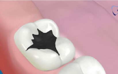 Empastes dentales: tipos y precio