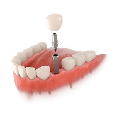 Carga inmediata de un implante