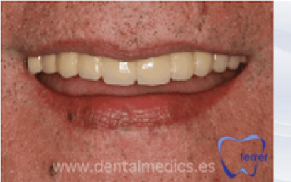 Implantes en toda la boca