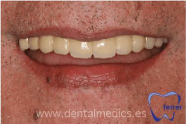 implantes dentales en toda la boca implantes dentales en toda la boca