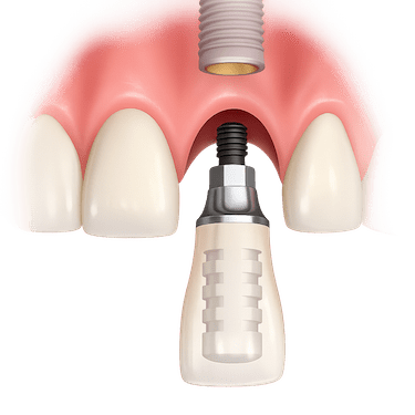¿En qué consiste la carga inmediata de implantes?