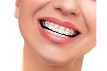 ortodoncia con brackets autoligables brackets autoligable