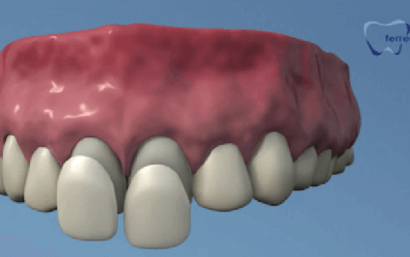 Precio de carillas dentales