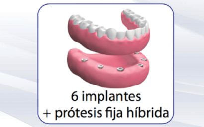 Precio de la prótesis híbrida sobre implantes
