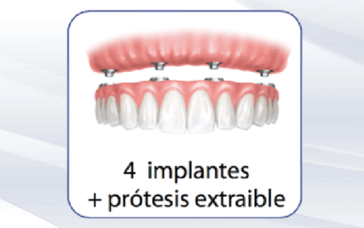 Prótesis dental removible sobre implantes dentales
