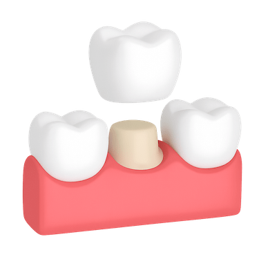 ¿Qué son las coronas dentales?