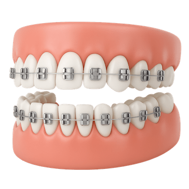 ¿Qué son los brackets?