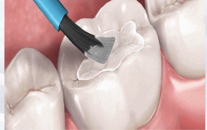 Selladores dentales: recomendaciones de nuestros dentistas